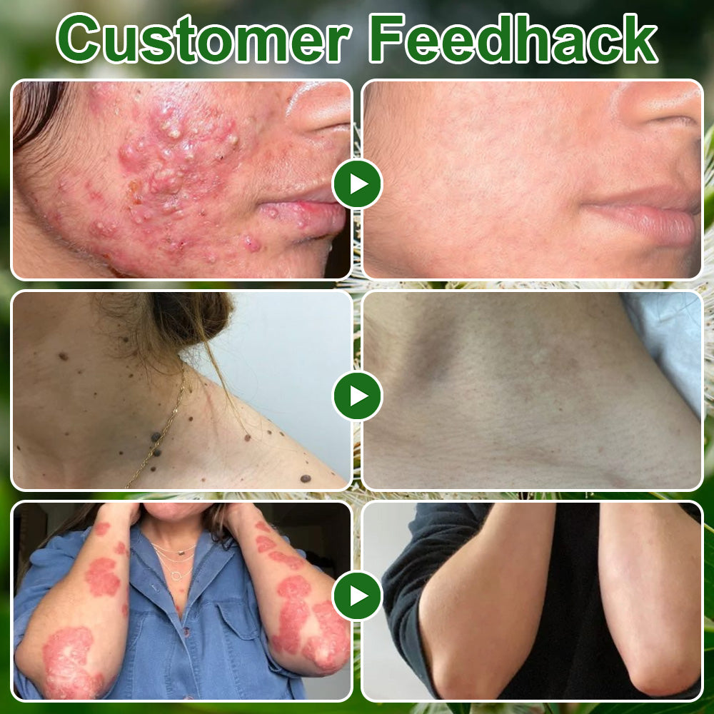 🌿𝐌𝐇𝐑𝐀-𝐀𝐏𝐏𝐑𝐎𝐕𝐄𝐃 ✅𝐳𝐯𝐨𝐞𝐯𝐨® 𝐓𝐞𝐚 𝐓𝐫𝐞𝐞 𝐎𝐢𝐥 𝐒𝐤𝐢𝐧 𝐓𝐫𝐞𝐚𝐭𝐦𝐞𝐧𝐭 𝐂𝐫𝐞𝐚𝐦 – Removes Skin Blemishes, Repairs Damaged Skin, Brightens & Anti-Ageing Care