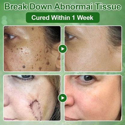 🌿𝐌𝐇𝐑𝐀-𝐀𝐏𝐏𝐑𝐎𝐕𝐄𝐃 ✅𝐳𝐯𝐨𝐞𝐯𝐨® 𝐓𝐞𝐚 𝐓𝐫𝐞𝐞 𝐎𝐢𝐥 𝐒𝐤𝐢𝐧 𝐓𝐫𝐞𝐚𝐭𝐦𝐞𝐧𝐭 𝐂𝐫𝐞𝐚𝐦 – Removes Skin Blemishes, Repairs Damaged Skin, Brightens & Anti-Ageing Care