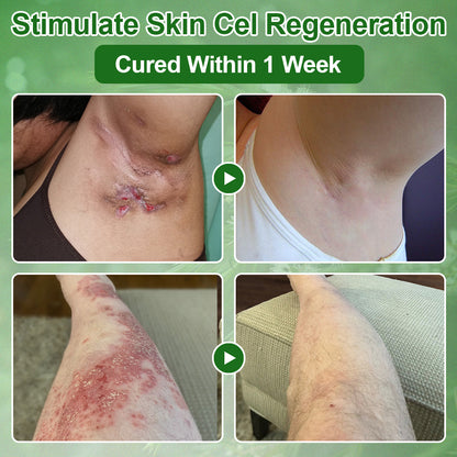 🌿𝐌𝐇𝐑𝐀-𝐀𝐏𝐏𝐑𝐎𝐕𝐄𝐃 ✅𝐳𝐯𝐨𝐞𝐯𝐨® 𝐓𝐞𝐚 𝐓𝐫𝐞𝐞 𝐎𝐢𝐥 𝐒𝐤𝐢𝐧 𝐓𝐫𝐞𝐚𝐭𝐦𝐞𝐧𝐭 𝐂𝐫𝐞𝐚𝐦 – Removes Skin Blemishes, Repairs Damaged Skin, Brightens & Anti-Ageing Care